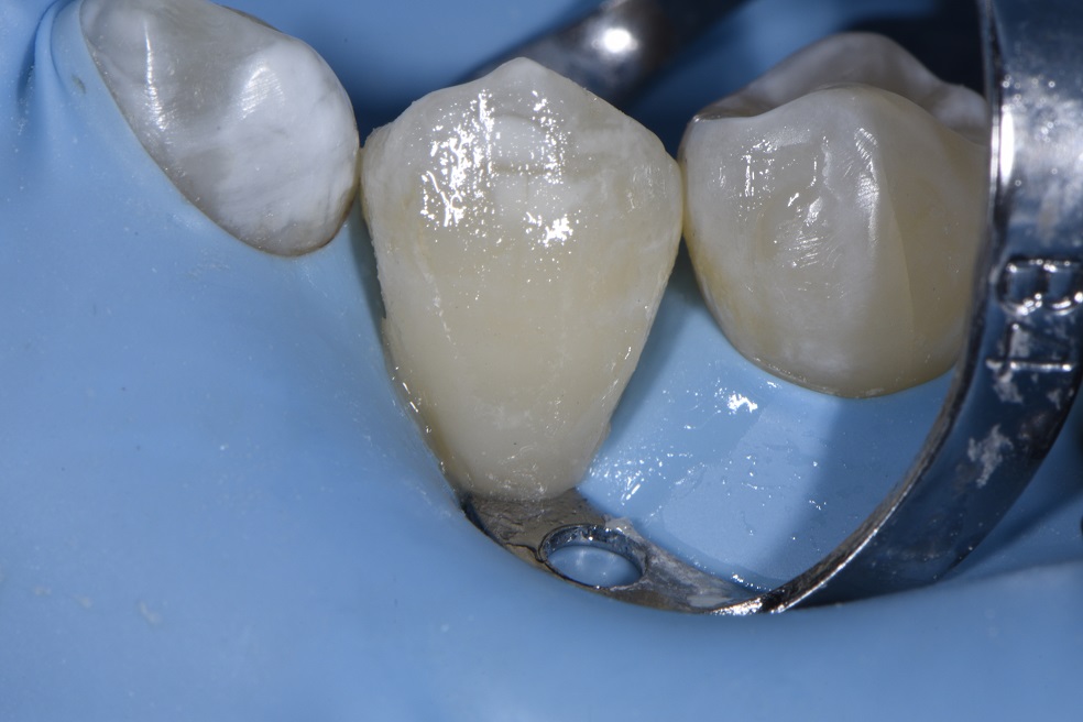 Restoring a dentist's cervical abrasion lesion
