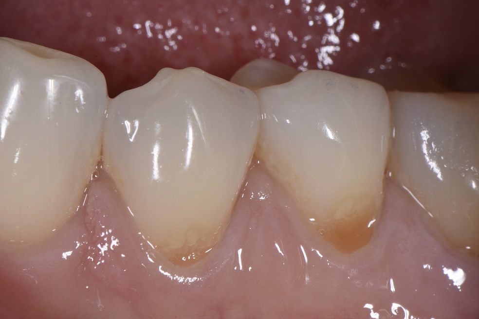 Class V cervical abrasion restorations