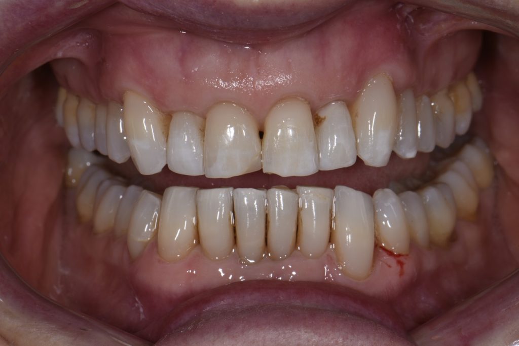 One Year Invisalign Invisalign 1 year result