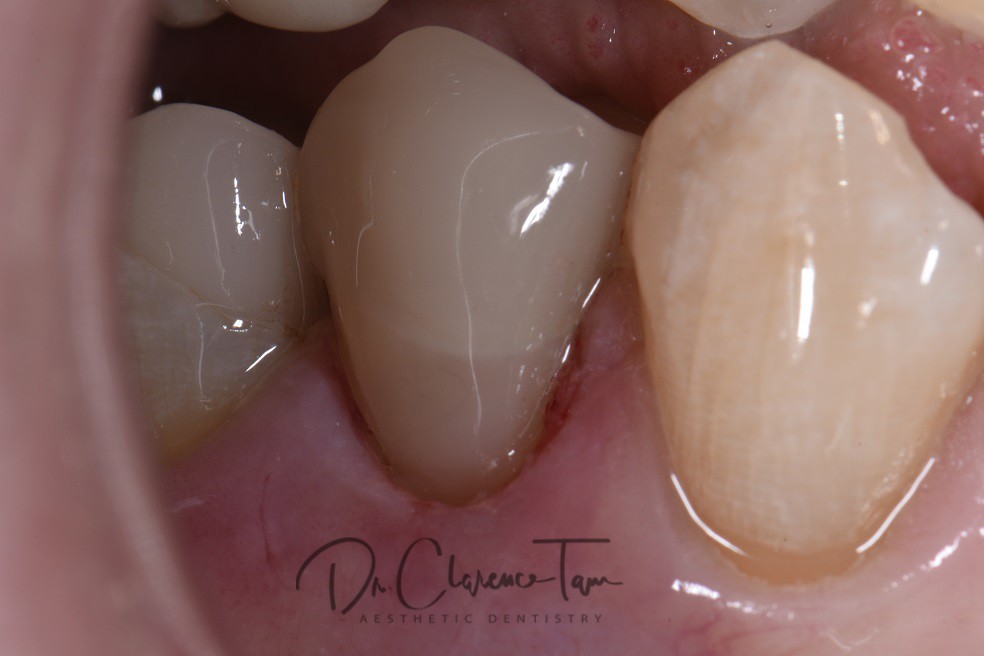 Sealing Old Crown Margins with New Restorations