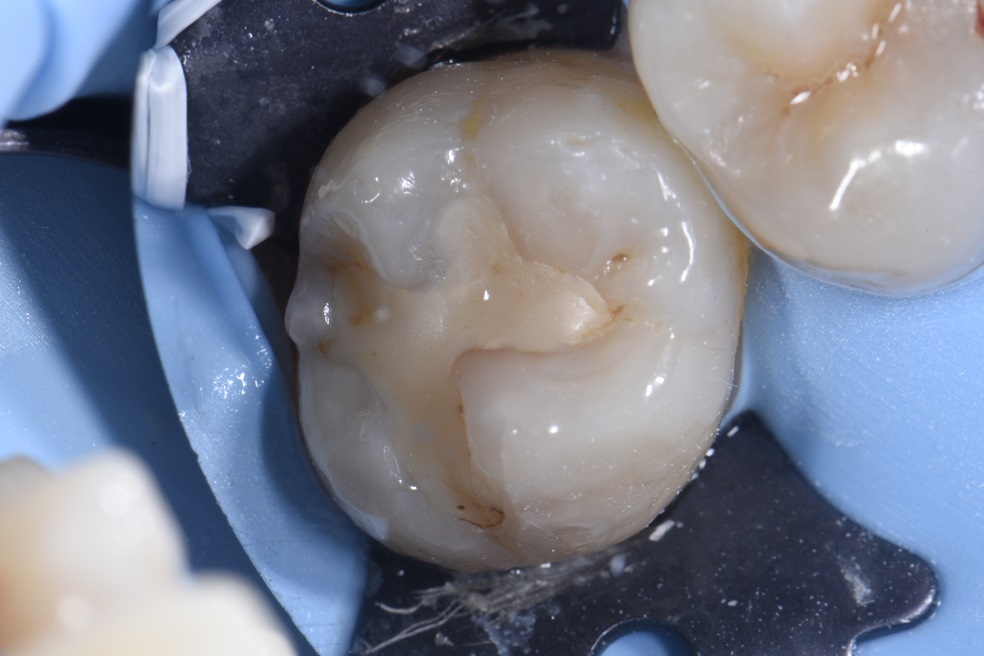 Large Filling Replacements With Biomimetic Composite