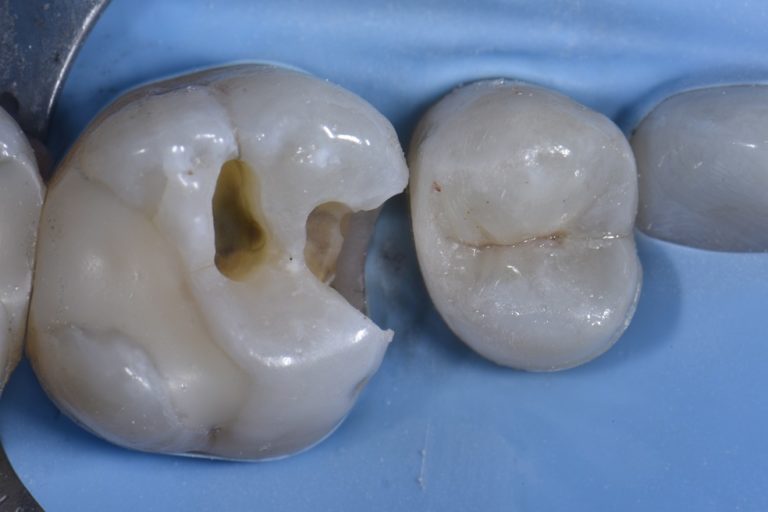 Biomimetic Replacements of Old Amalgam Fillings