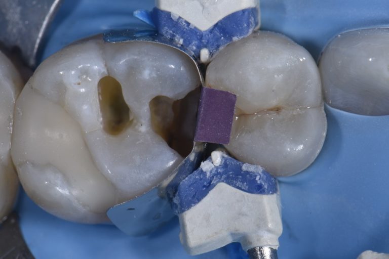 Biomimetic Replacements of Old Amalgam Fillings