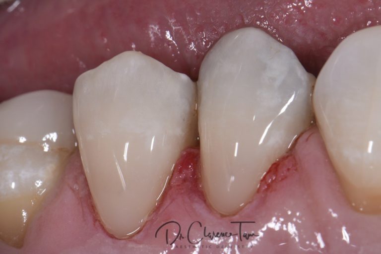 Class V Restorations Done Invisibly