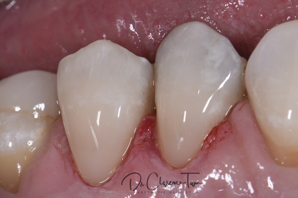 Class V Restorations Done Invisibly