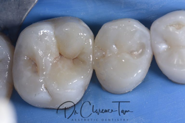 Blending Composites to Match Tooth Structure Perfectly