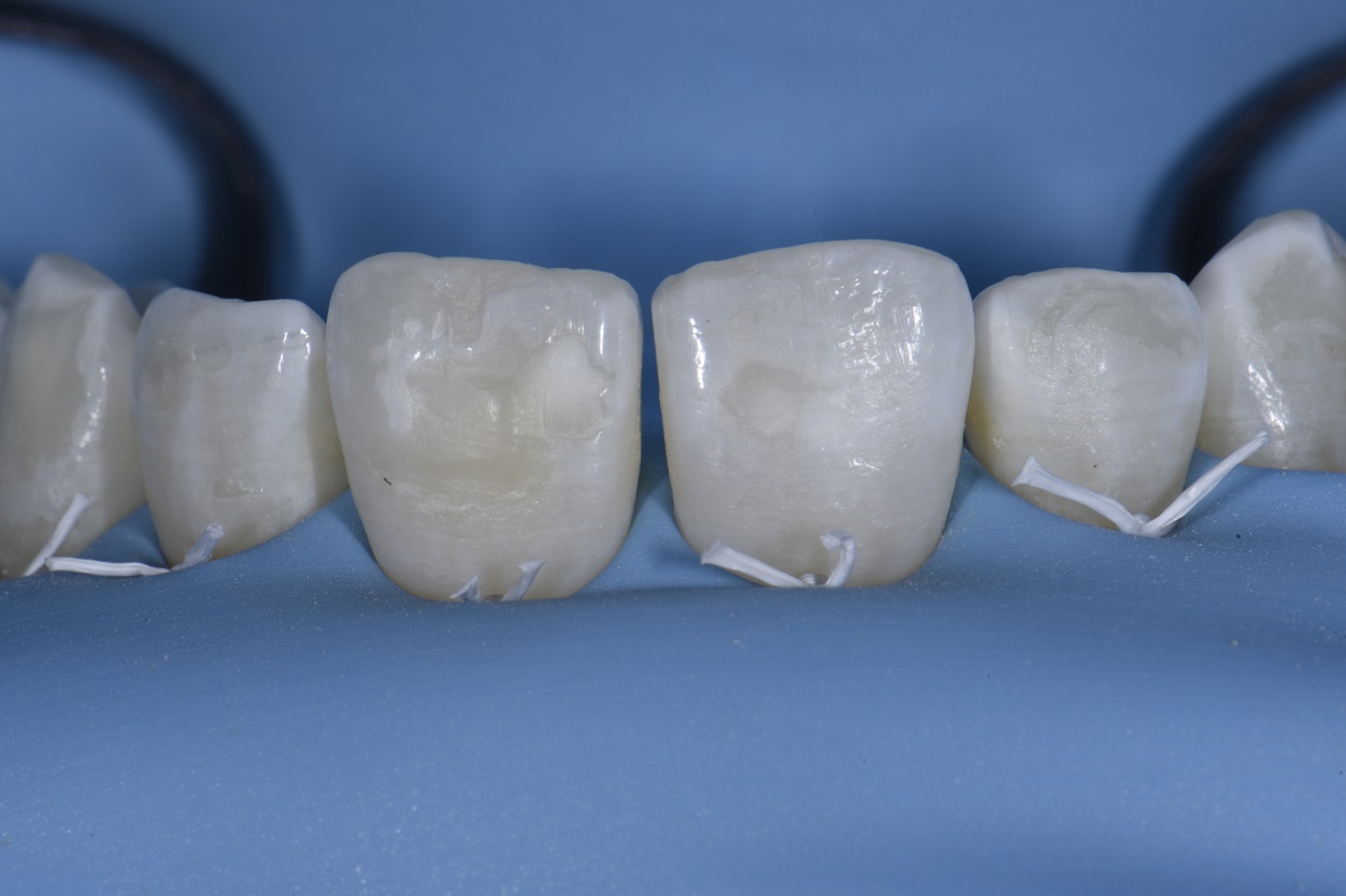 Post Orthodontic Composite Additions to Refine Smile Design