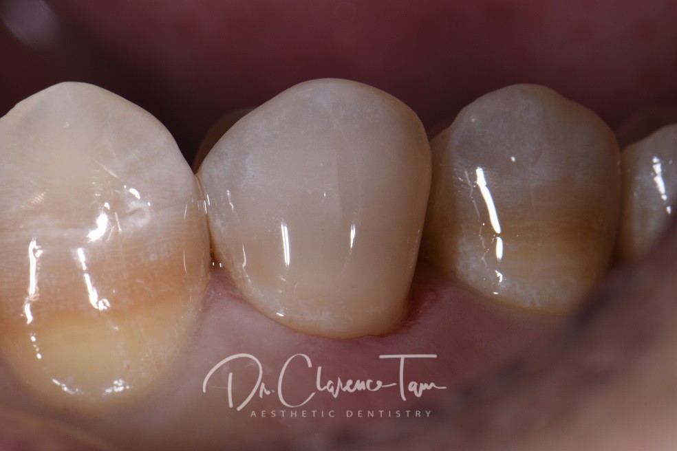 Class V restorations on tetracycline stained teeth
