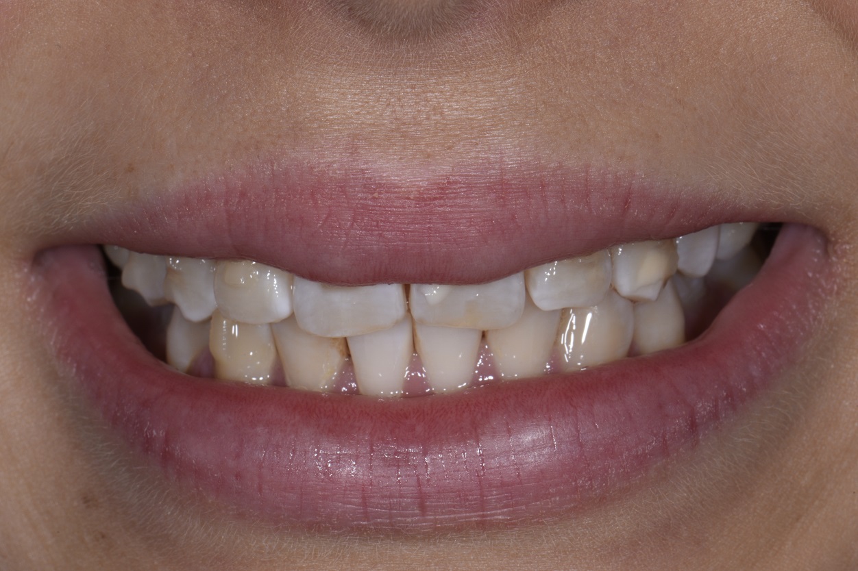 NonInvasive Composite Veneers