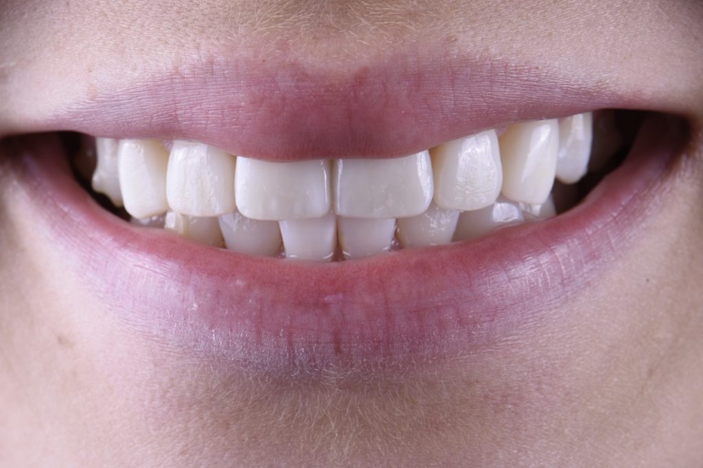 Non-Invasive Composite Veneers Non-Invasive Composite Veneers