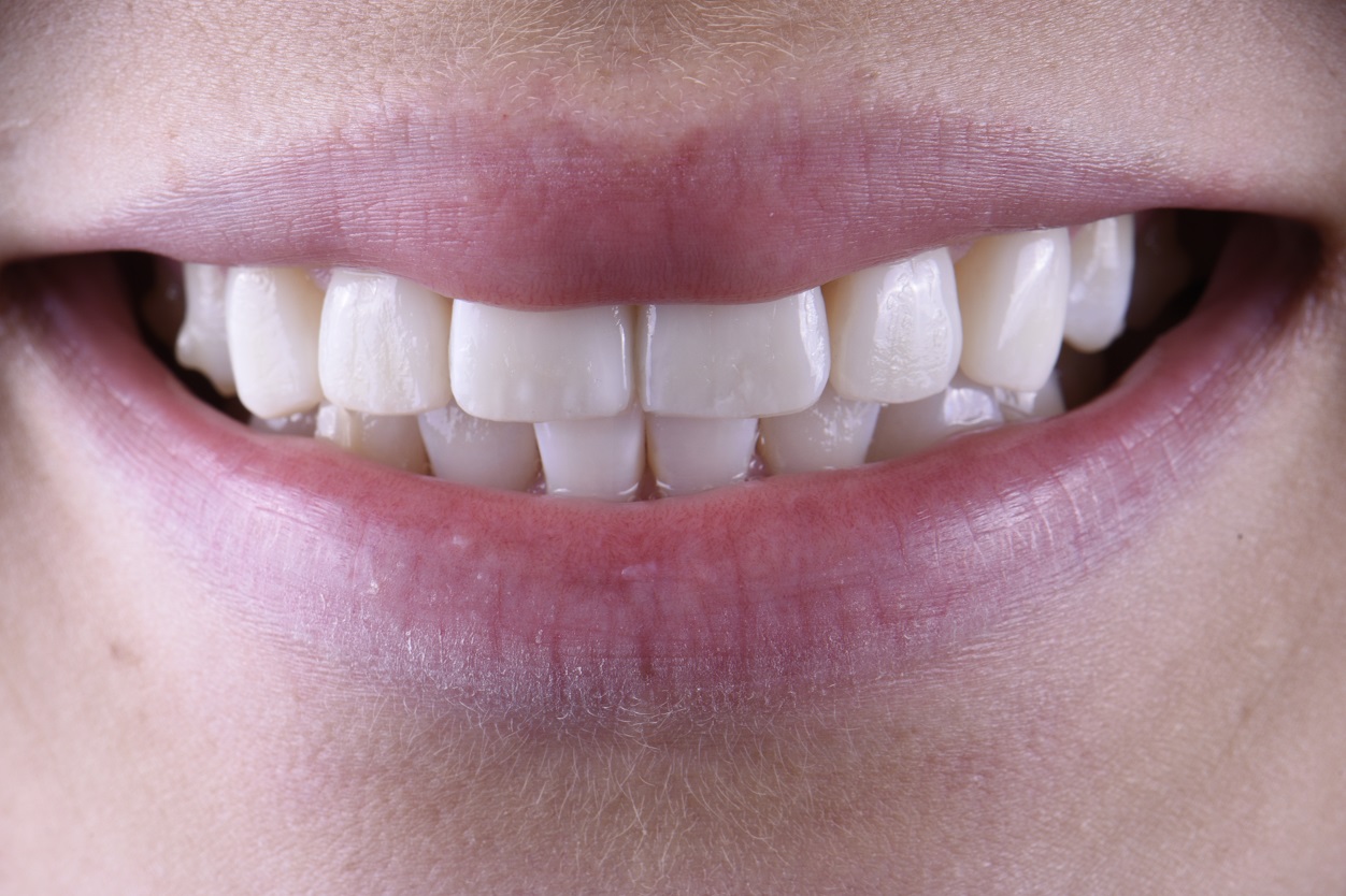 NonInvasive Composite Veneers