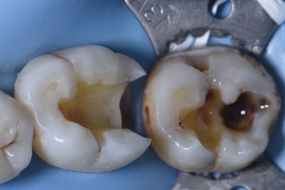 Deep cavities and fillings that copy nature