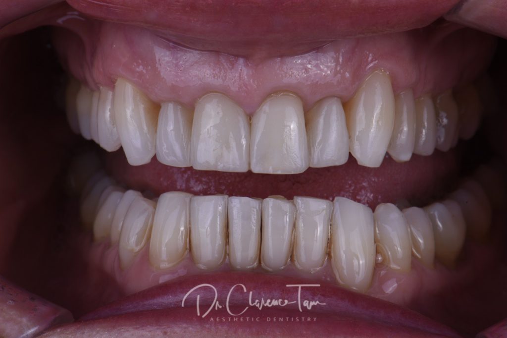 3B Protocol Braces Bleaching Bonding