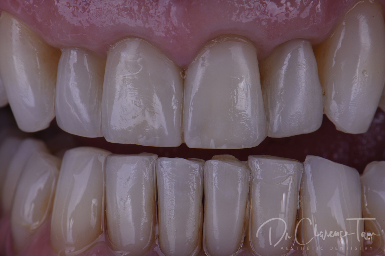 3B Protocol Braces Bleaching Bonding