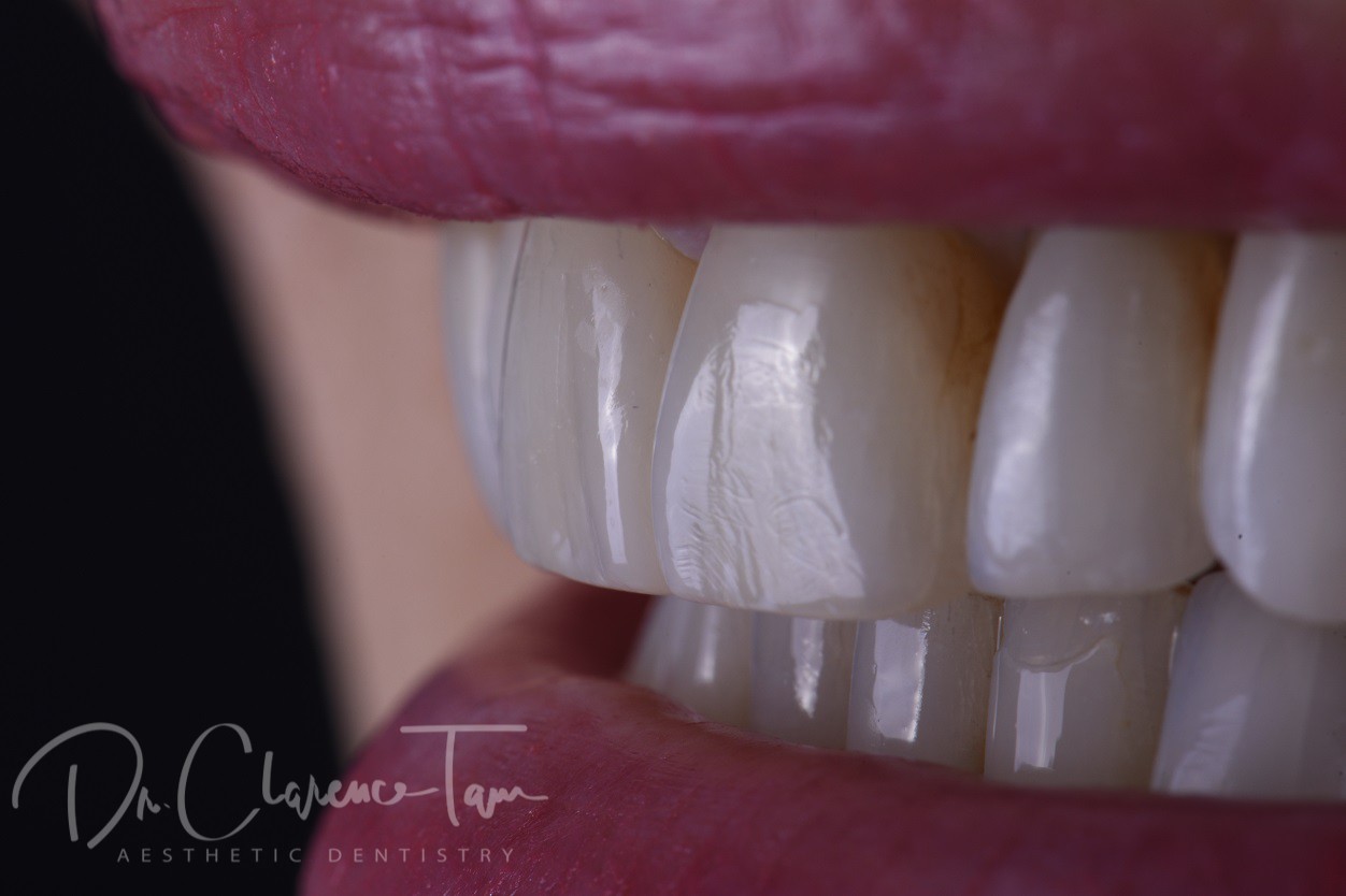 3B Protocol Braces Bleaching Bonding