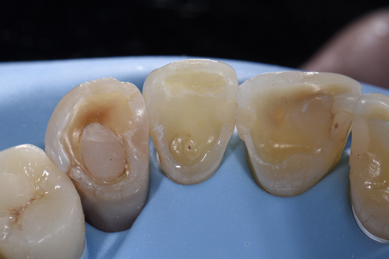 Reversing Wear on the palatal surfaces of front teeth