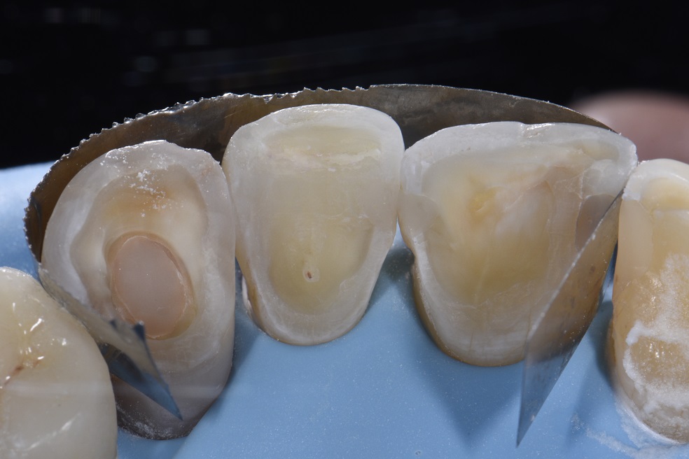 Reversing Wear on the palatal surfaces of front teeth