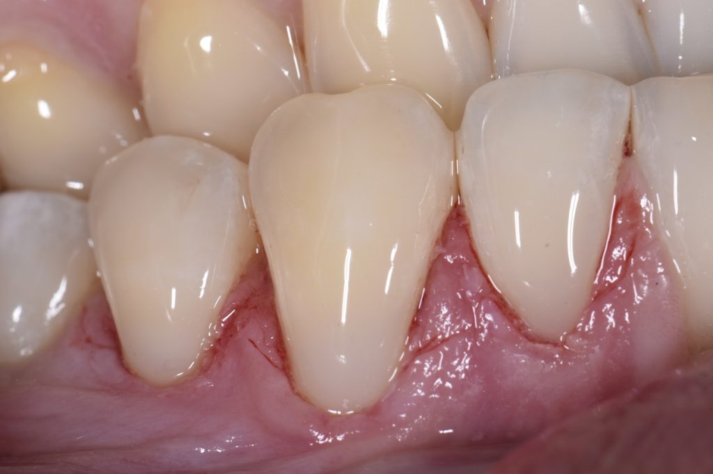 Cervical Abrasion Lesions Restored with GC Essentia U