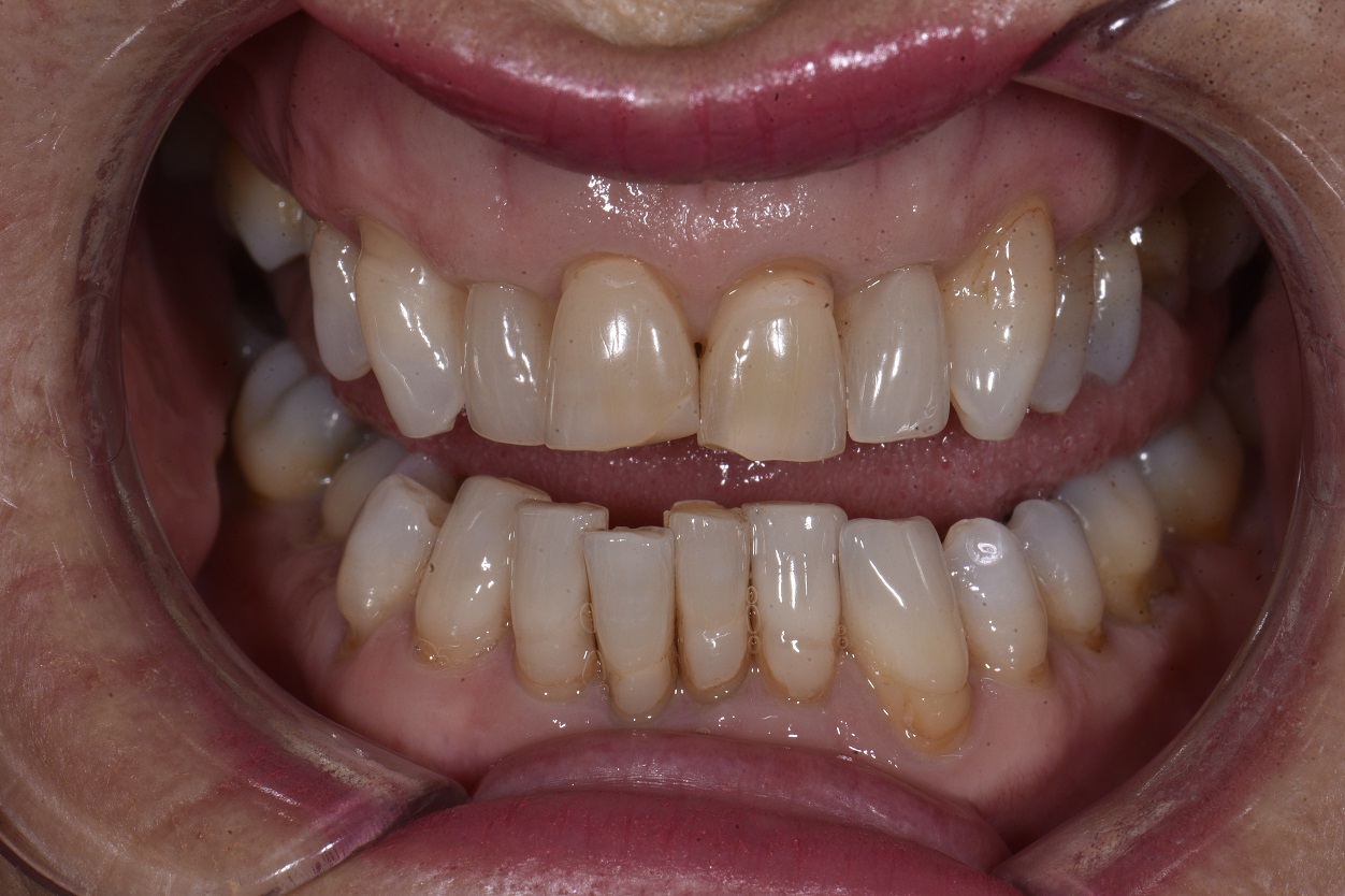 3B Protocol Braces Bleaching Bonding