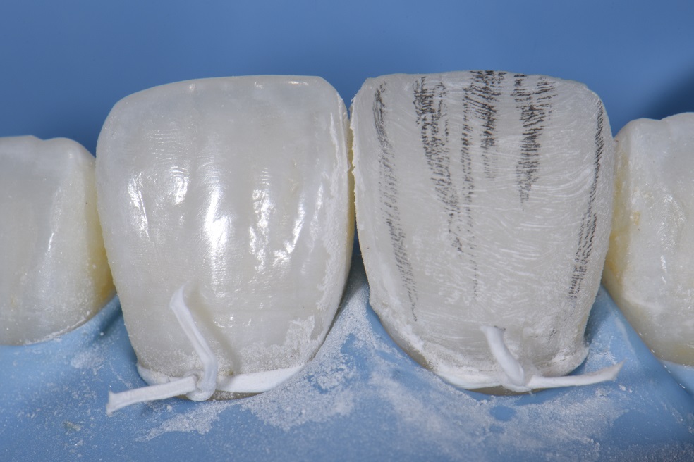 Class IV fracture freehand repair with Kerr Harmonize composite resin