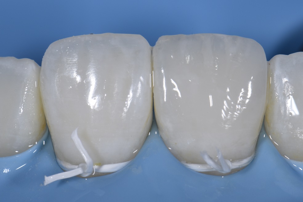 Class IV fracture freehand repair with Kerr Harmonize composite resin