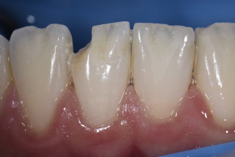 Enamel chips in a lower incisor