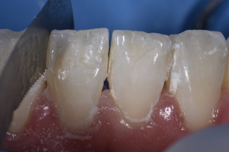 Enamel chips in a lower incisor