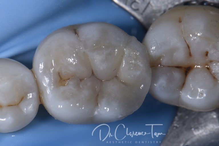 Stabilizing Cracks in AmalgamFilled Teeth