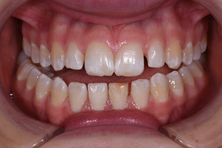 Peg Lateral Incisor Esthetic Correction using Empress Direct