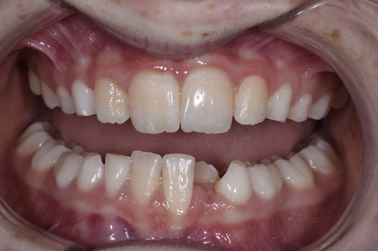 Dental Fractures Restored Invisibly