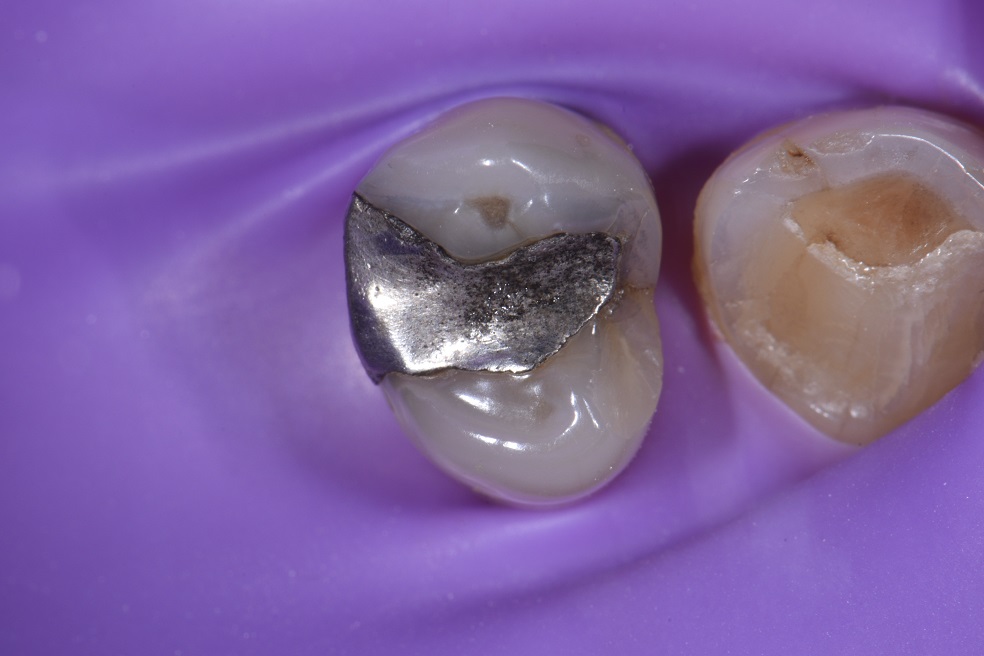 Triangular ridge invagination of Class II restorations