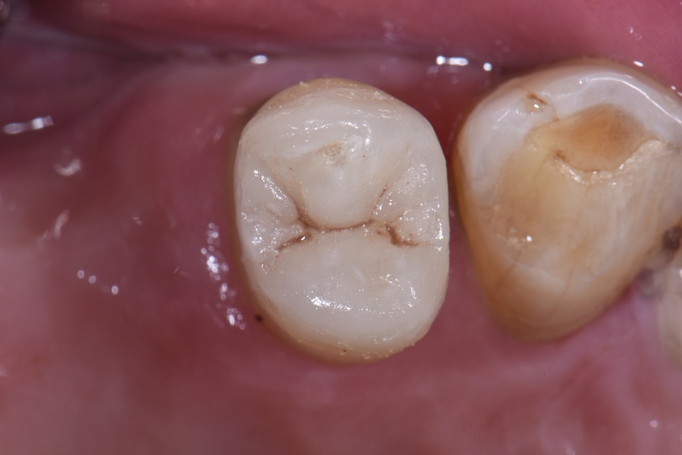 Triangular ridge invagination of Class II restorations