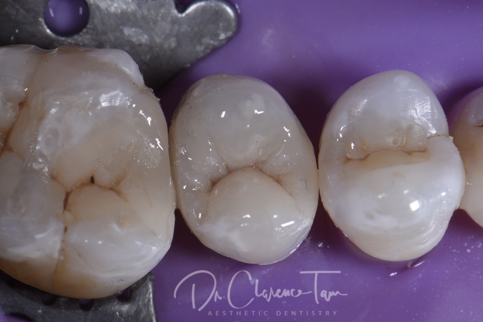 Replacing Large Old Amalgams with Fresh Bonded Composite