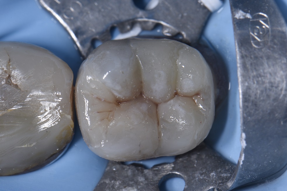 Replacing Extensive Amalgam Restorations with Composite Cores