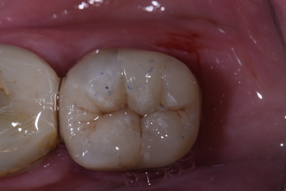 Replacing Extensive Amalgam Restorations with Composite Cores