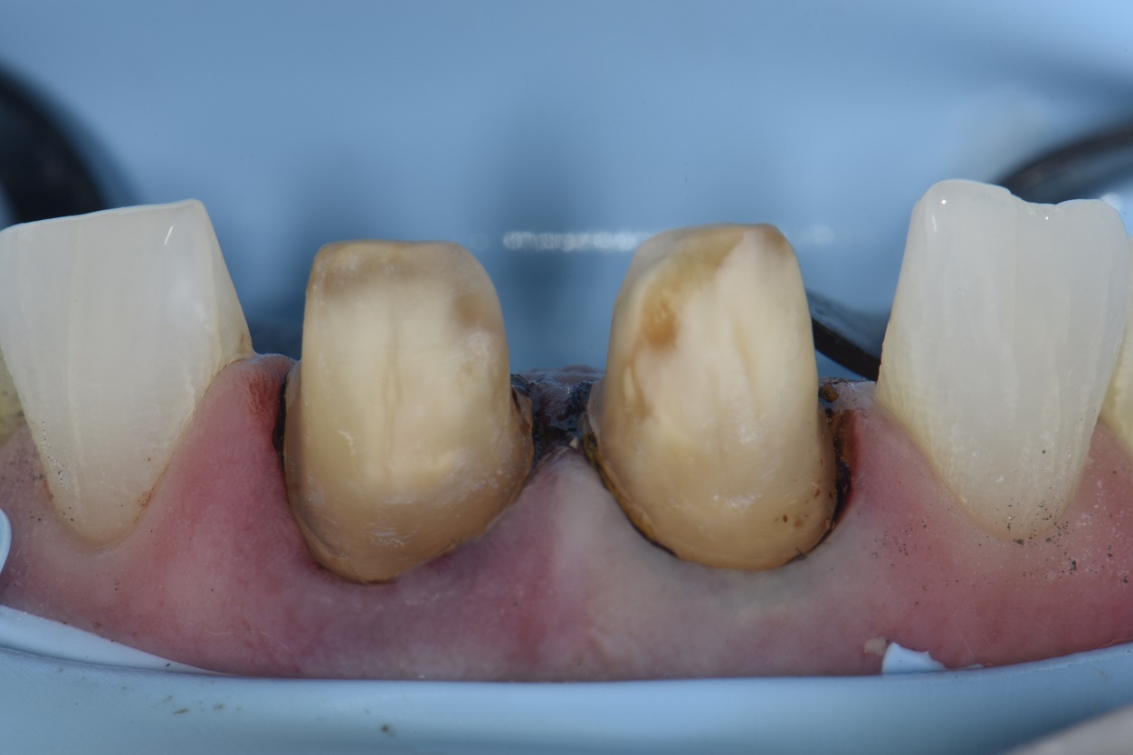 Workflow to Replace Two Old Crowns