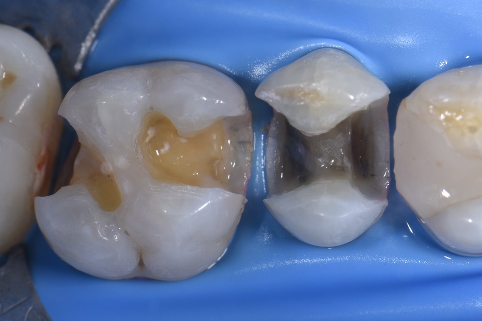 Classic Class II restorations done biomimetically