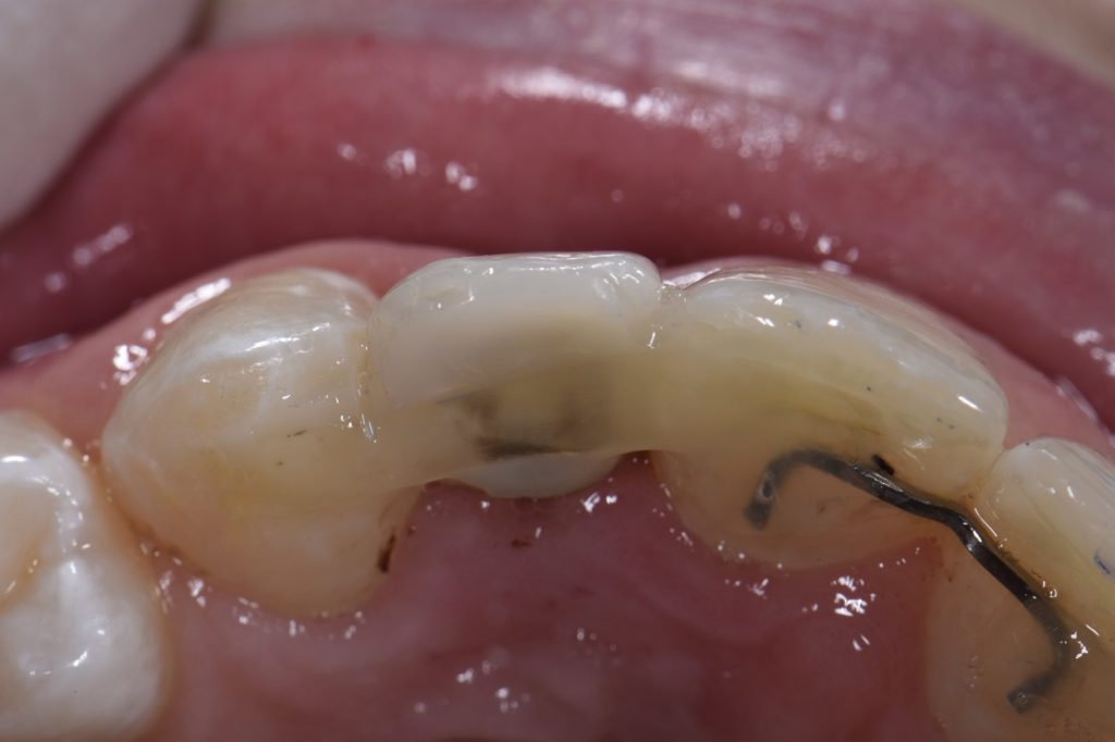 Temporary Composite Bridges