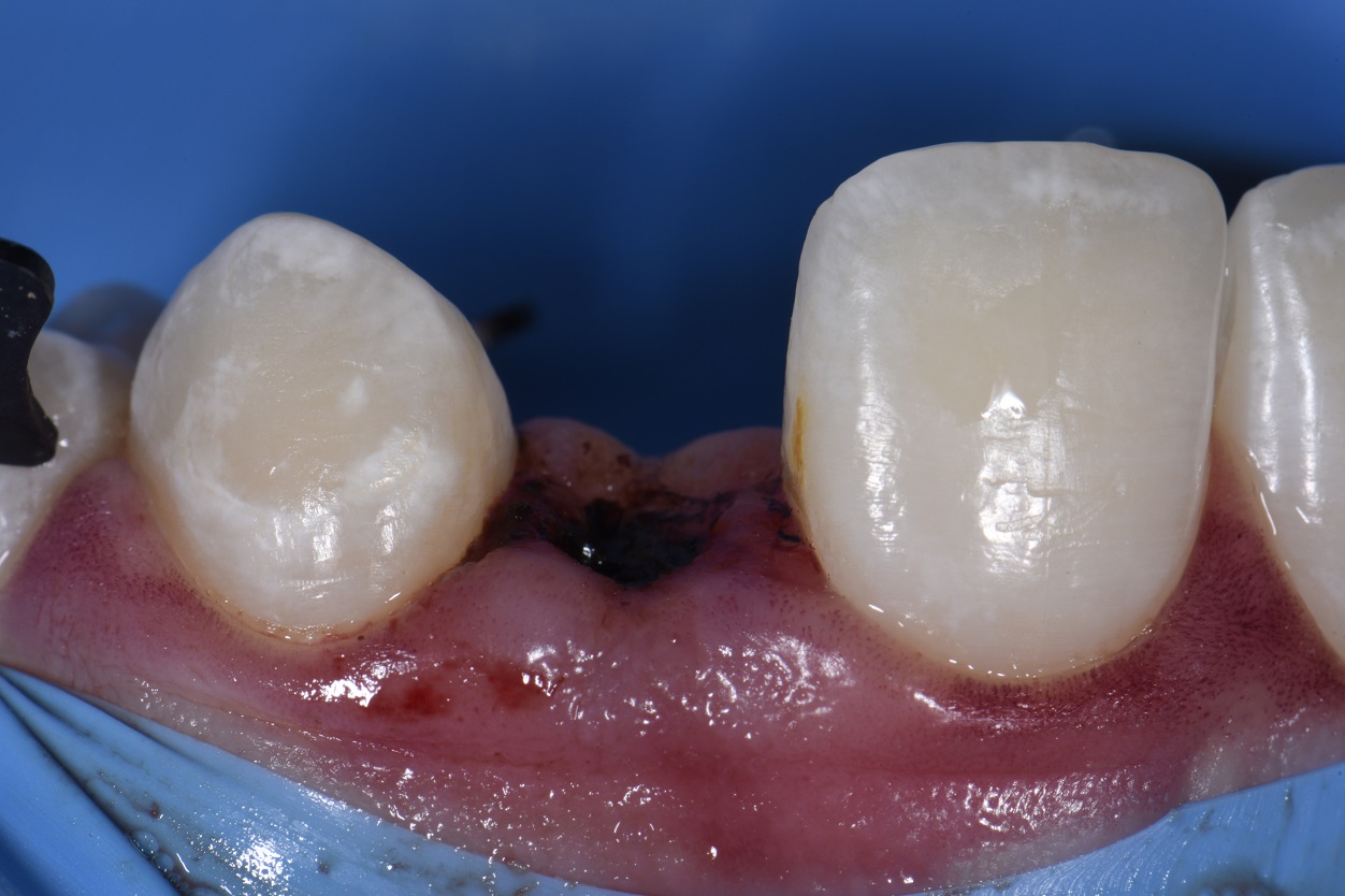 Temporary Composite Bridges