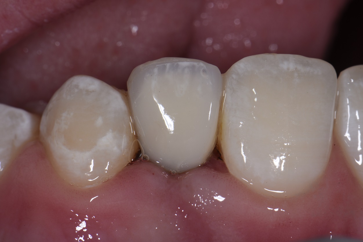 Temporary Composite Bridges