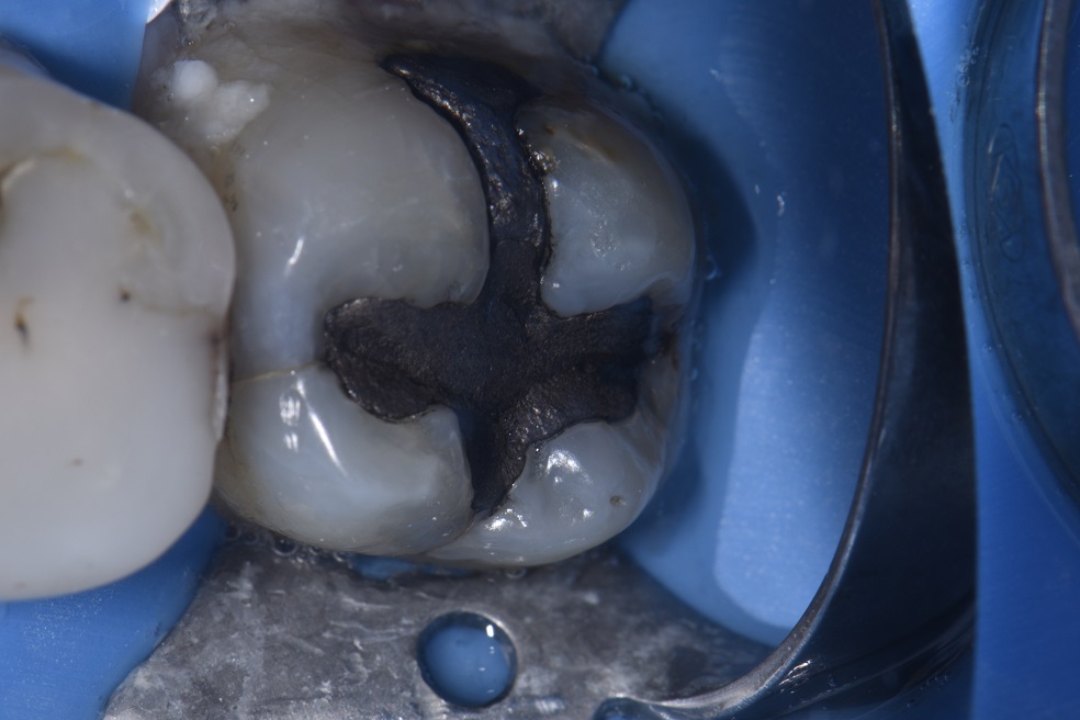Stabilizing Cracked Amalgam Filled Teeth