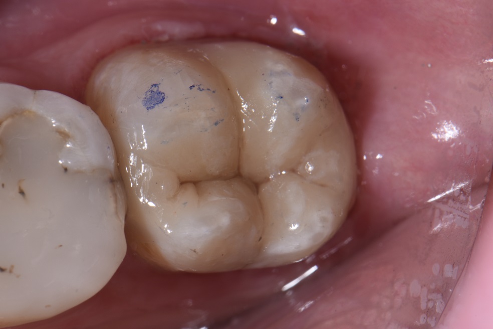 Stabilizing Cracked Amalgam Filled Teeth