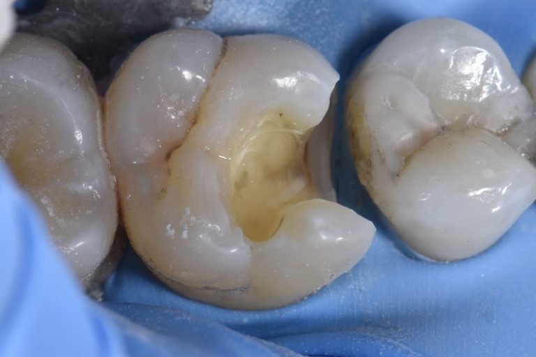 Amalgam Replacement with Bonded Composite Resin