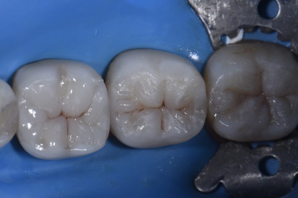 Quadrant Dentistry with Clinicians Choice Evanesce