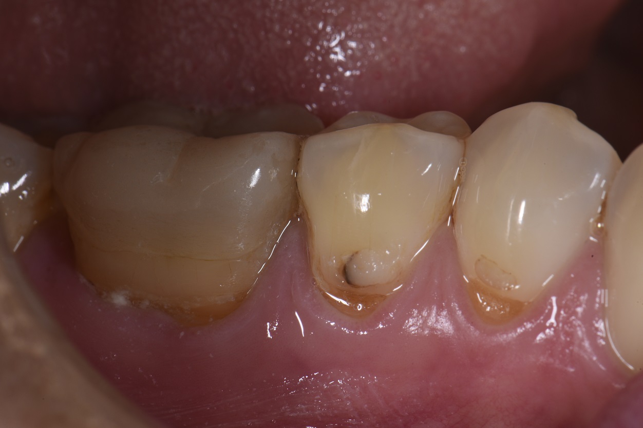 Class V restoration multiple replacements