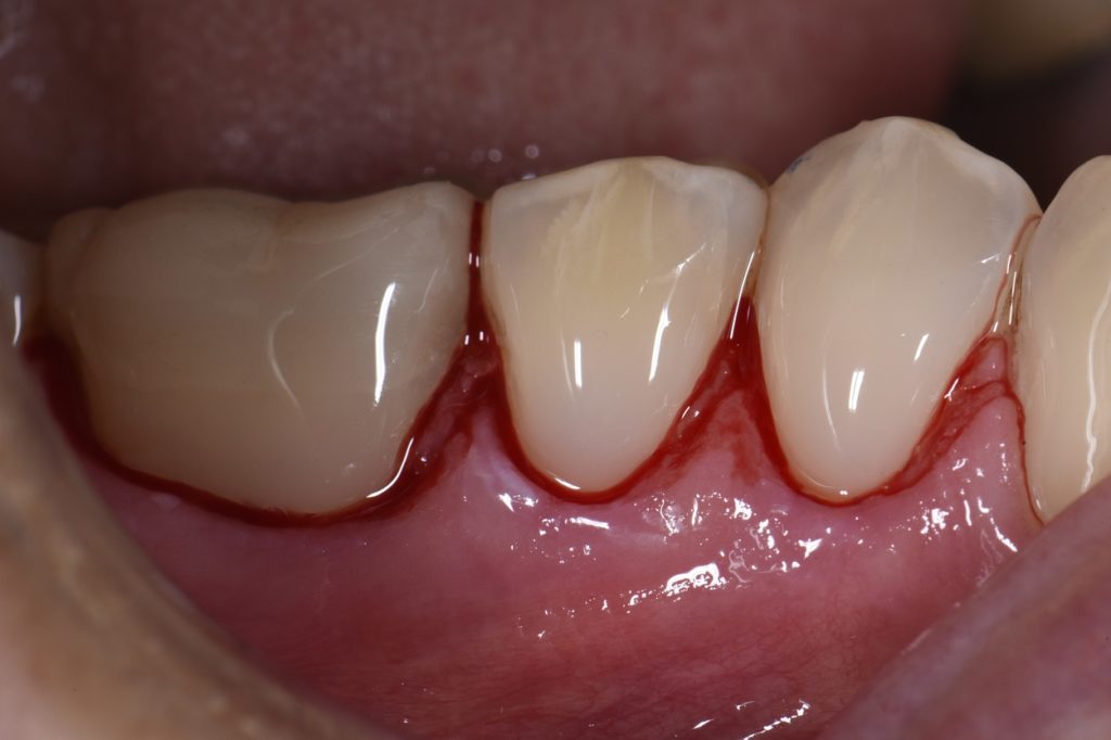 Class V restoration multiple replacements