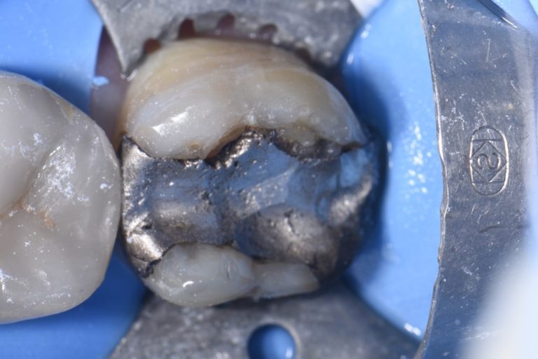 Bioactive Composite with Giomer Technology