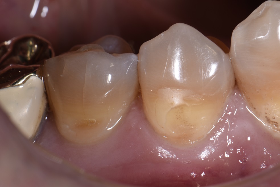 Class V restorations on tetracycline affected teeth