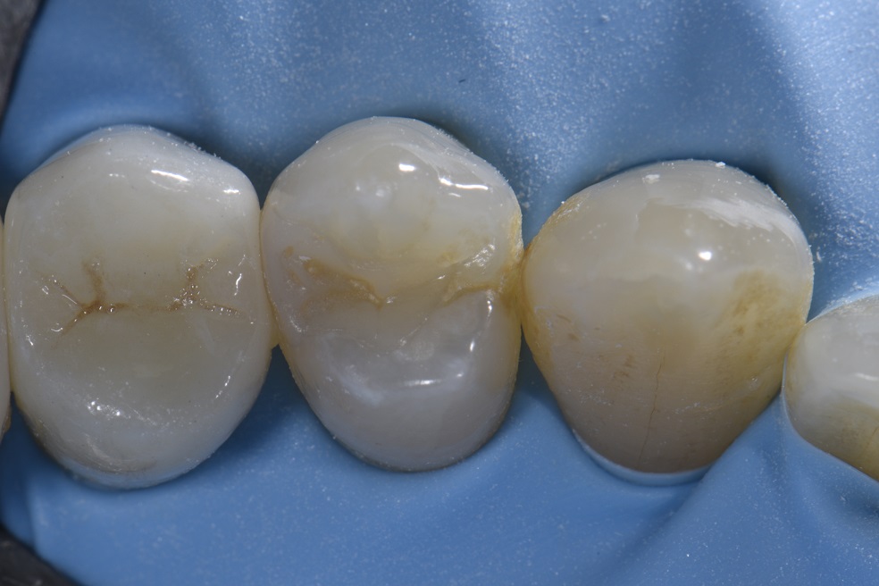 Minimal shrinkage composite technology