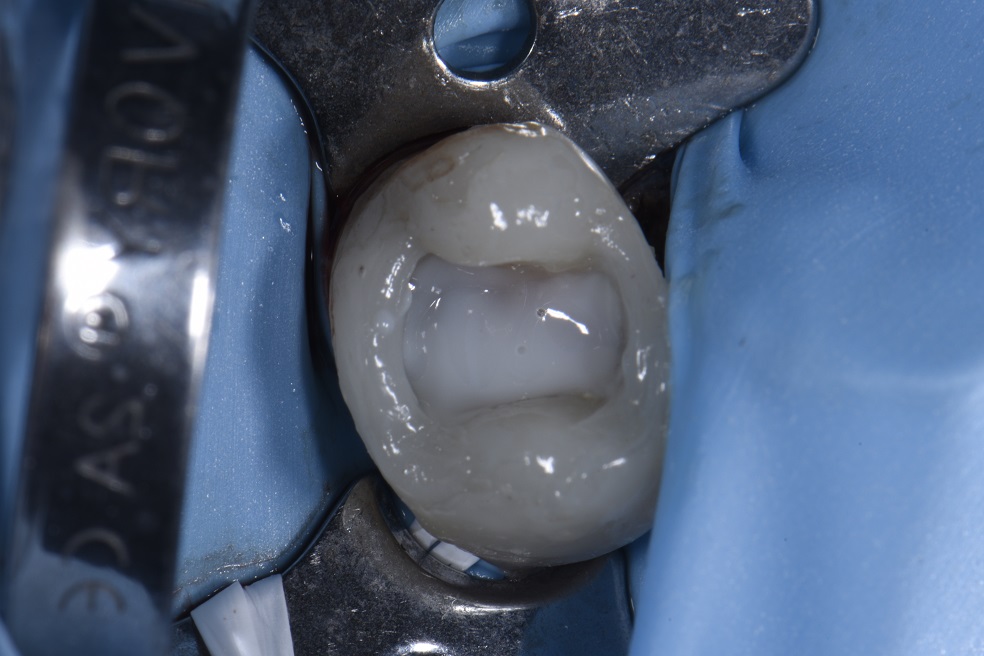 Complex Reconstruction of Near-Hopeless Teeth